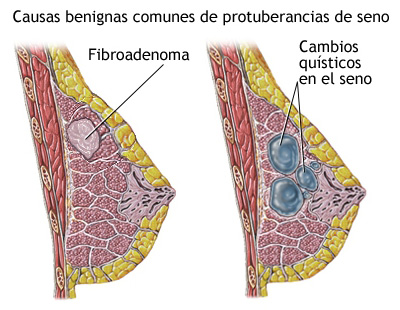 Mamografía examen