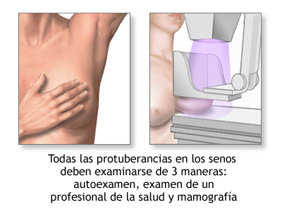 Mamografía examen